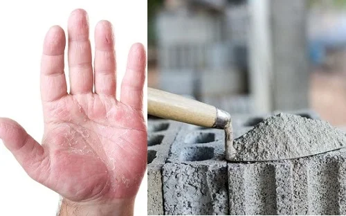 Dị ứng xi măng là gì? Dấu hiệu nghiêm trọng và cách chữa