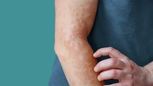 Bị dị ứng bôi dầu gió đượch không 