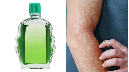 Bị dị ứng có nên bôi dầu gió không? Giải đáp từ chuyên gia