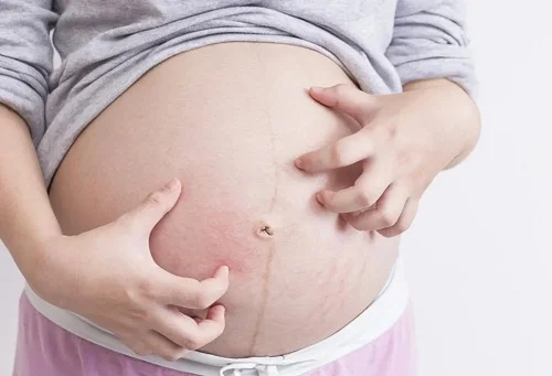 Dị ứng thai kỳ có sao không?Cách xử lý an toàn cho mẹ và bé