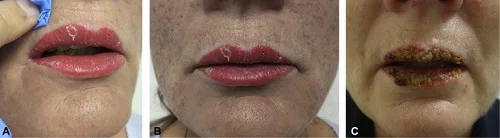 Bị dị ứng mực xăm môi bao lâu thì khỏi