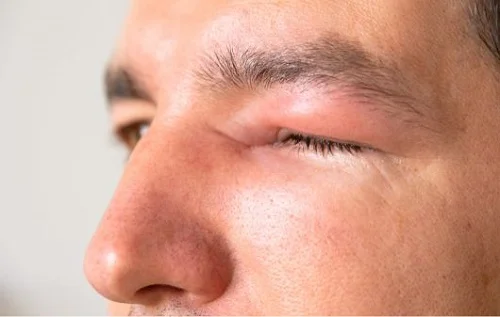 bị dị ứng mắt nên làm gì