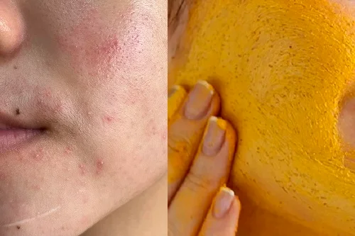 Bị dị ứng nghệ phải làm sao? Nguy hiểm không? Mẹo xử lý