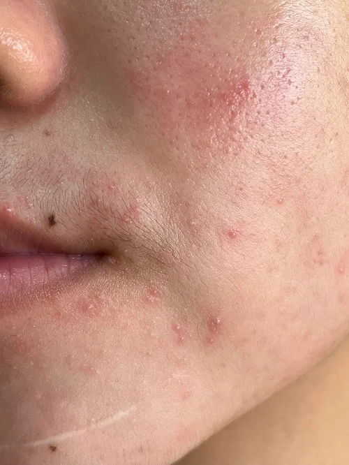 Biểu hiện của dị ứng tinh bột nghệ như thế nào? biểu hiện của dị ứng tinh bột nghệ