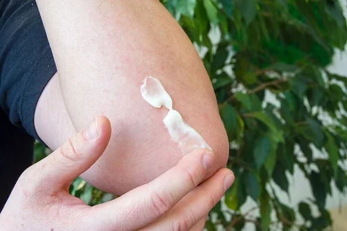 Da bị dị ứng xi măng bôi thuốc gì