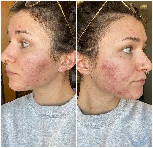 dấu hiệu dị ứng niacinamide