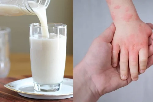 Nguyên nhân dị ứng Lactose là gì? Cách nhận biết và xử lý triệt để