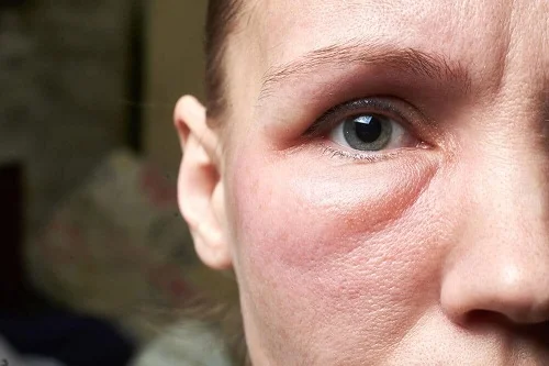 Dị ứng có bị sưng mắt không? Bao lâu thì hết? Hướng xử lý