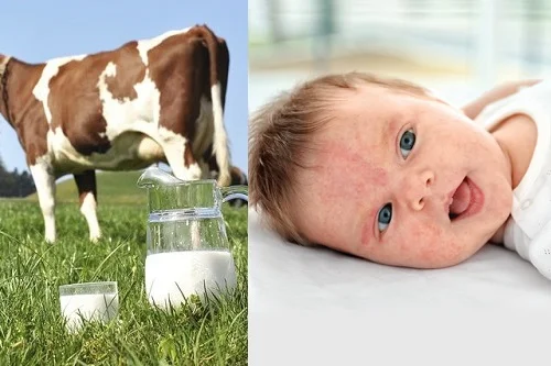 Vì sao trẻ bị dị ứng đạm sữa bò? Dấu hiệu, xử lý không tái phát