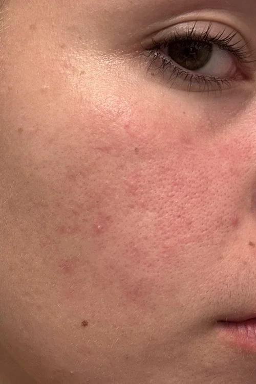 dị ứng niacinamide 10 zinc 1