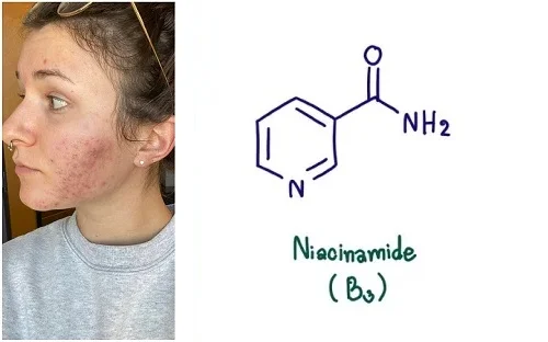 Dị ứng Niacinamide (B3): Dấu hiệu dễ bị nhầm lẫn và xử trí