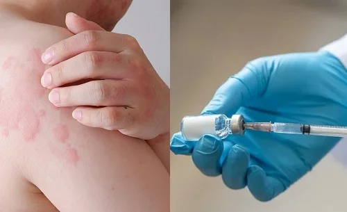 Dị ứng có tiêm được Vaccine không? Giải đáp cho mỗi trường hợp