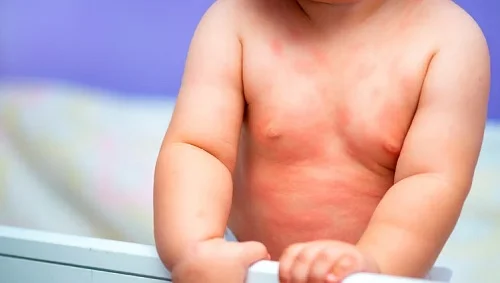 Hình ảnh bị dị ứng đạm sữa bò