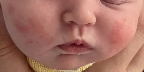 Hình ảnh trẻ bị dị ứng đạm sữa bò