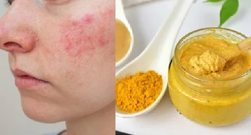 Bị dị ứng có nên đắp mặt nạ không? Sai lầm khiến da nặng hơn