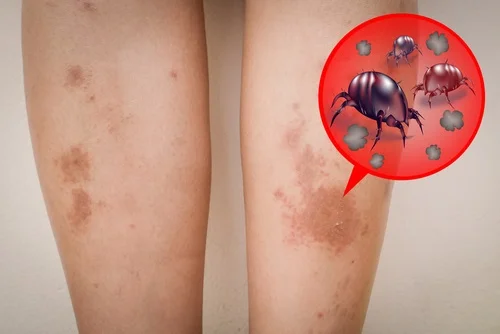 Dị ứng mạt nhà là gì? Biểu hiện và cách điều trị dứt điểm