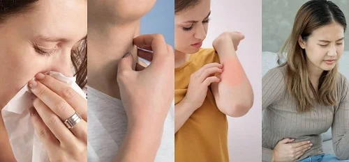 Triệu chứng dị ứng mật ong