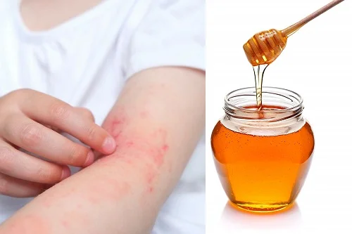 Di ứng mật ong phải làm sao? Cách chữa đơn giản ngay tại nhà