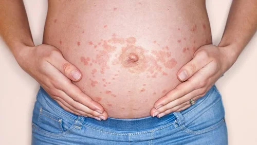 Viêm da dị ứng khi mang thai 3 tháng đầu 