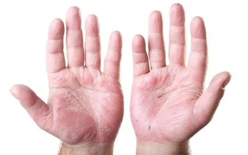 viêm da tiếp xúc dị ứng xi măng