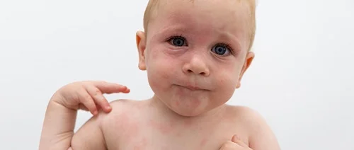 Xem hình ảnh bé bị dị ứng đạm sữa bò 