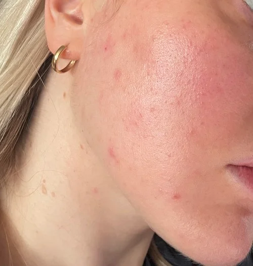 bệnh dị ứng ánh nắng mặt trời