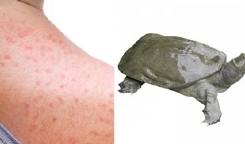 Dị ứng ba ba: Dấu hiệu, cách chữa và phòng ngừa tái phát