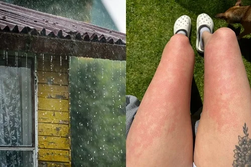 Bị dị ứng nước mưa là bệnh gì? Biểu hiện, xử lý, phòng tránh