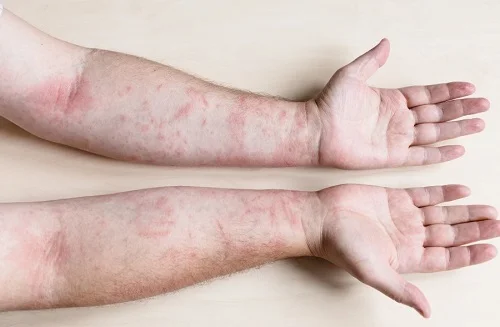 Những dấu hiệu dị ứng cua bé Dấu hiệu dị ứng cua bé