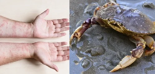 Dị ứng cua nên làm gì? Cách nhận biết dễ dàng và xử lý