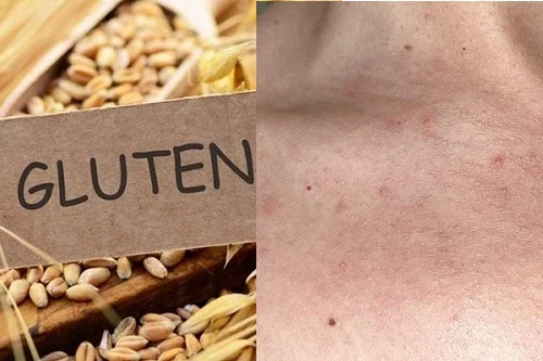 Dị ứng gluten là bệnh gì? Biểu hiện và hướng điều trị dứt điểm