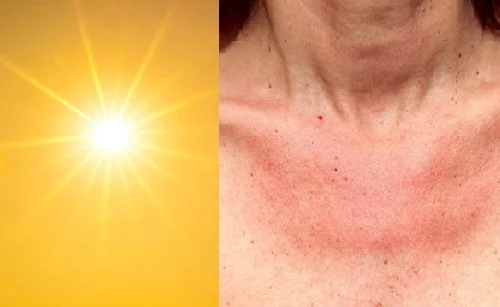 Bị dị ứng ánh nắng mặt trời: Biểu hiện, xử lý và phòng ngừa