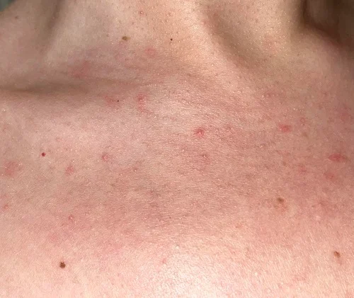 Triệu chứng dị ứng gluten là gì