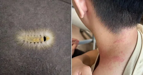 Những biểu hiện bị dị ứng lông sâu róm Biểu hiện bị dị ứng lông sâu róm