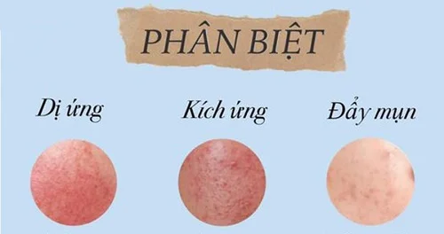 Những biểu hiện của dị ứng retinol Biểu hiện của dị ứng retinol