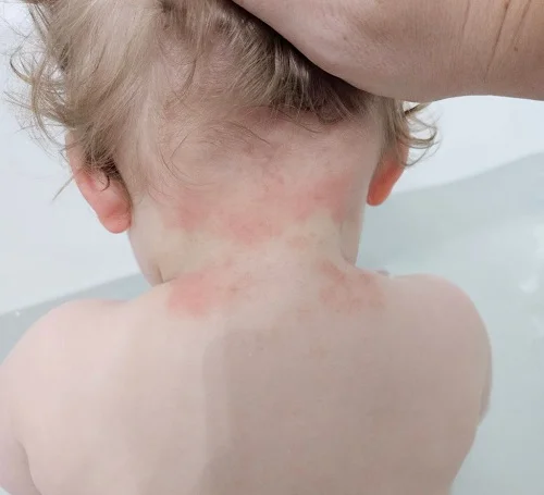 Biểu hiện trẻ dị ứng như thế nào biểu hiện trẻ dị ứng