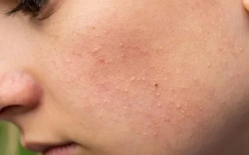 Da bị dị ứng retinol bị nổi mụn trắng Da bị dị ứng retinol