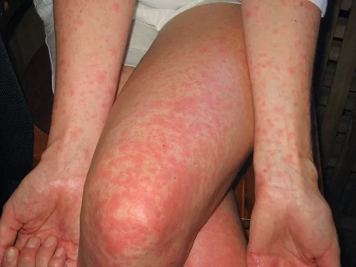 Những dấu hiệu dị ứng với lông sâu róm Dấu hiệu dị ứng với lông sâu róm