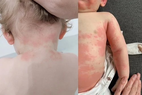 Trẻ bị dị ứng phải làm sao? Dấu hiệu và cách điều trị dị ứng ở trẻ em