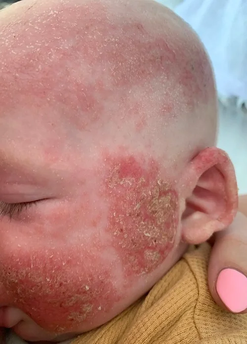 Kem dưỡng ẩm cho bé viêm da cơ địa nên dùng loại nào Kem dưỡng ẩm cho bé viêm da cơ địa