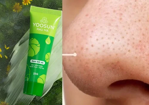 Kem Yoosun Rau má có trị mụn đầu đen không? Góc nhìn da liễu