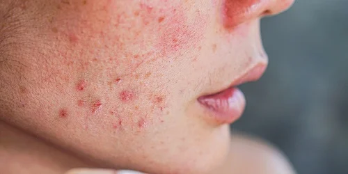 Nguyên nhân dị ứng với retinol là gì Nguyên nhân dị ứng với retinol