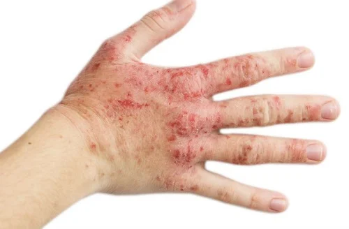 Cách chữa dị ứng dầu máy hiệu quả nhất Cách chữa dị ứng dầu máy