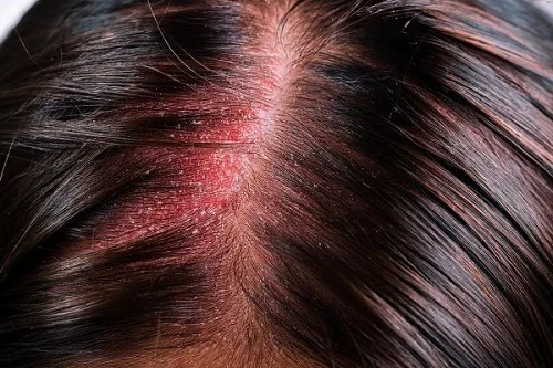 Dấu hiệu dị ứng dầu gội ở da đầu Dấu hiệu dị ứng dầu gội