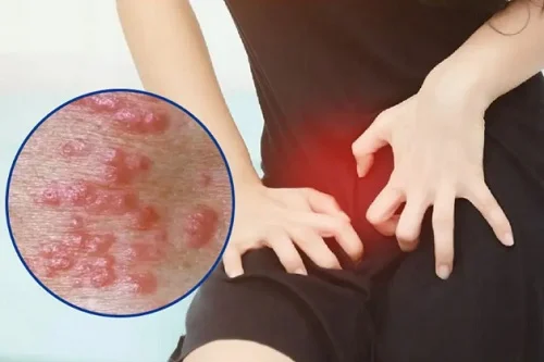 Dấu hiệu dị ứng với dung dịch vệ sinh phụ nữ như thế nào Dấu hiệu dị ứng với dung dịch vệ sinh phụ nữ