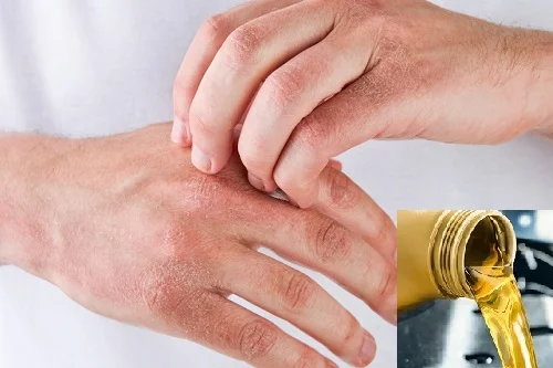 Dị ứng dầu máy: Biểu hiện dễ bị nhầm lẫn và cách xử lý
