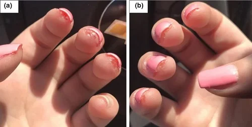 Thợ nail bị dị ứng sơn gel do tiếp xúc sơn gel thường xuyên Thợ nail bị dị ứng sơn gel