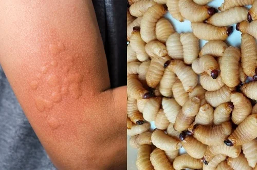 Biểu hiện và cách chữa dị ứng đuông dừa an toàn tại gia