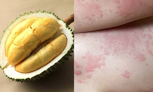 Vì sao bị dị ứng sầu riêng? Cách nhận biết và xử lý