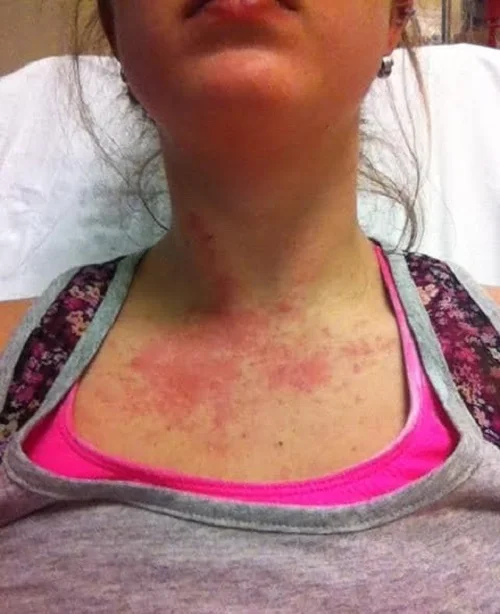 Dấu hiệu dị ứng hạt điều